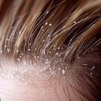 How to Use Rosemary and cloves for hair growth + Benefits and Risks 11 Rosemary And Clove Hair for Scalp infection